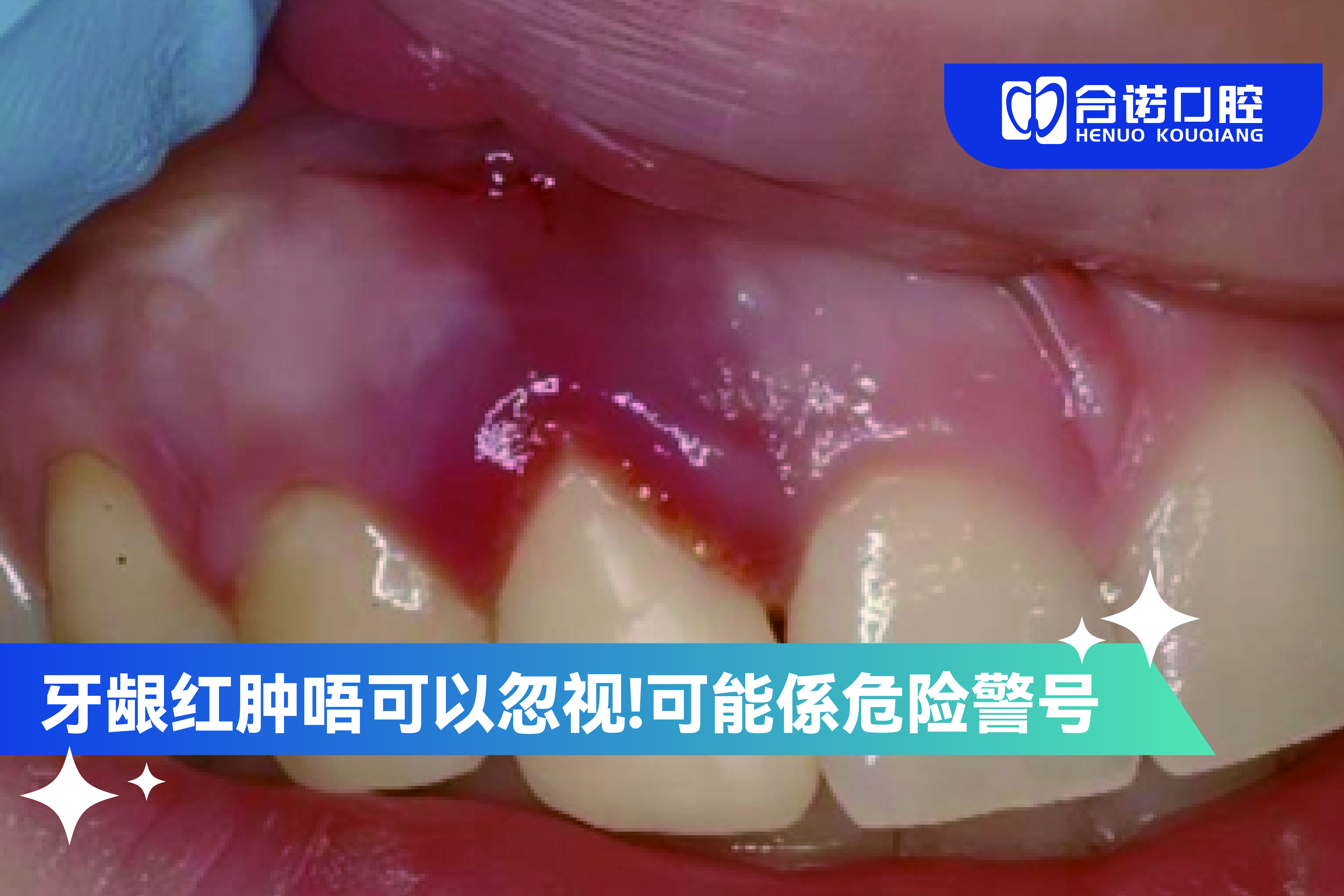 牙龈红肿唔可以忽视 可能係身体俾你嘅警号